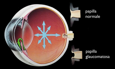 Schema Glaucoma